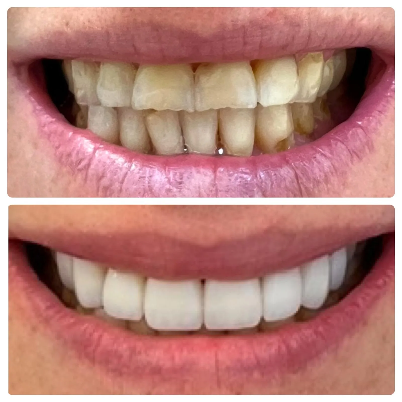 قبل وبعد قشور – تجميل الابتسامة حيفا